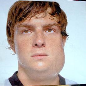 mumps