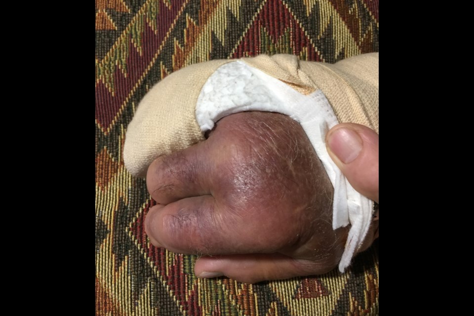 An 80 year old man had his hand bitten and broken trying to save his dog from an attack at the Champlain Park dog park. Submitted.