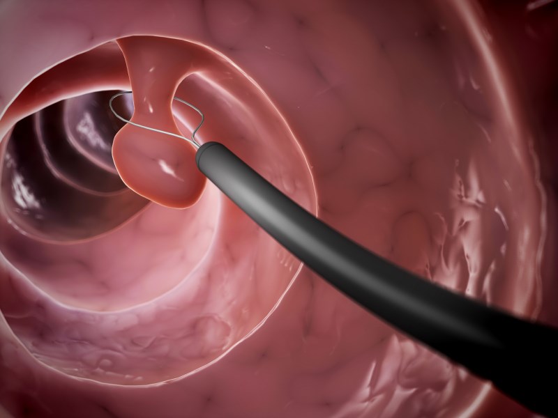 Colonoscopy: Removal of a polyp. Photo courtesy of russellhavranekmd.com