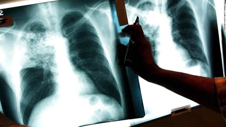 tuberculosis, BK Reader, NYC Health Department, Fort Greene Health Center, Mycobacterium tuberculosis, Fort Greene Chest Center, latent TB, active TB, cough, chest pain, fever, chills, appetite loss,