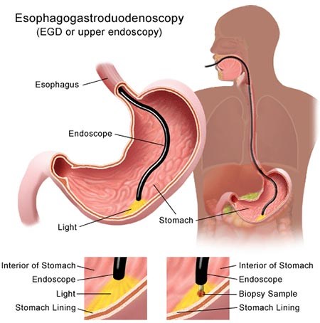 endoscopy , Gastroenterology, BK Reader, NYU Langone - Brooklyn, stomach pain, ulcers, gastritis, diarrhea, constipation, bloating, heartburn,