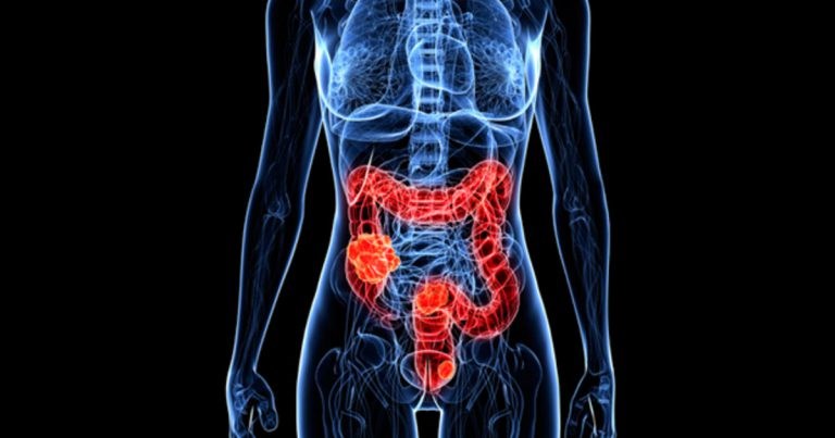 Colon Cancer