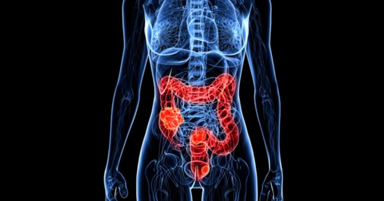 Colon Cancer