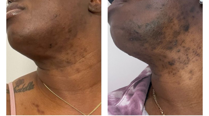Brooklyn laser studio helps people of color battle hair growth problems - BKReader Brooklyn laser studio helps people of color battle hair growth problems - BKReader
