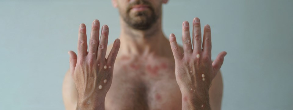 Male,Hands,Affected,By,Blistering,Rash,Because,Of,Monkeypox,Or