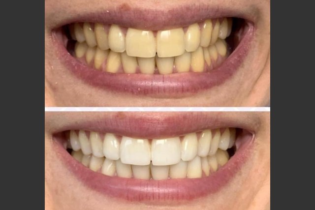 Pola Light-before-and-after-1