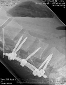 After removing the shattered remains of his L3 lumbar, doctors fused his L2 and L4 vertebrae together using five screws and a piece of metal. Photo provided.