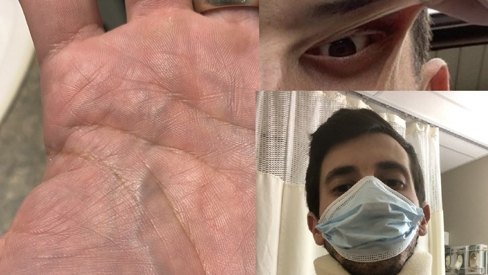 Louis Themeles shows some of his Lyme disease symptoms in this photo.