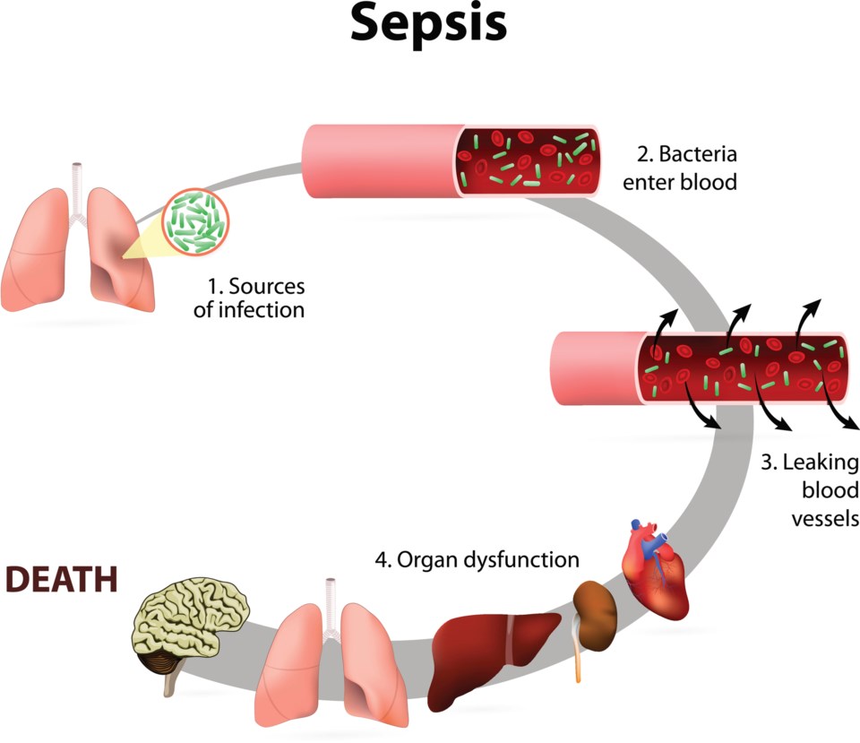 sepsis