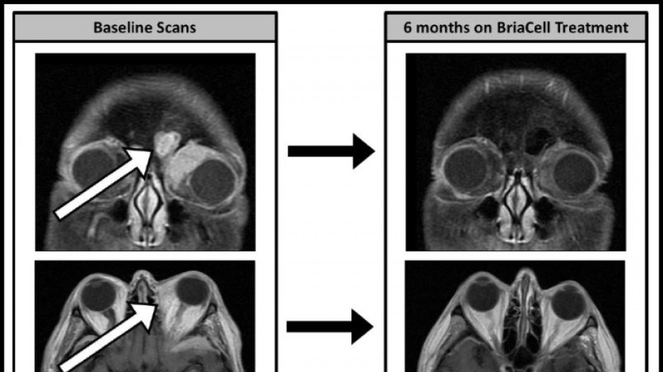 briacelltreatment-briacell_0