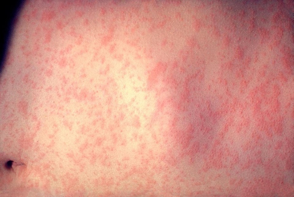 measles