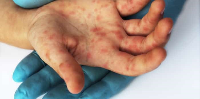 Red rashes on the palm of the hand / Shutterstock