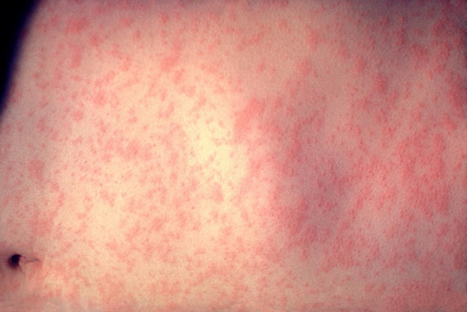 New measles case