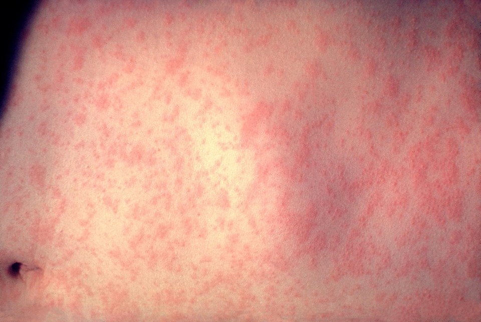 New measles case