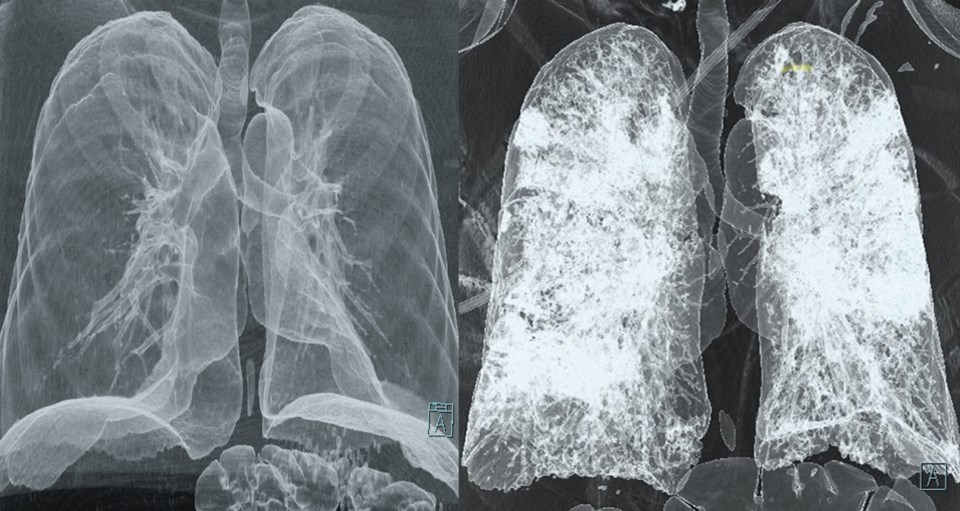 CT scan COVID-19 lungs