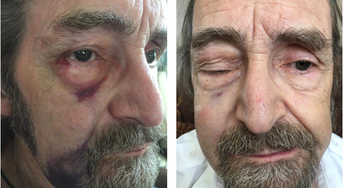 Security guard Glen Warner was left with a broken orbital bone after being punched while confronting a man smoking in Riverside Park. Warner underwent surgery on July 7.
