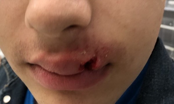 Autistic teen assaulted