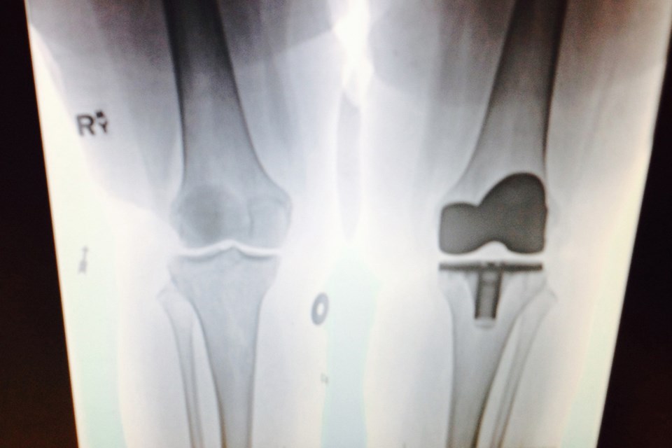 Courier reporter Sandra Thomas snapped a picture of the X-ray showing her new knee.