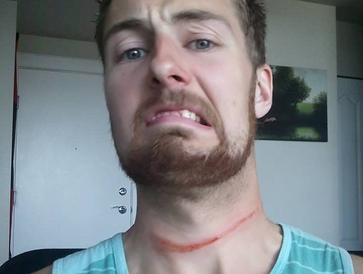 Derek Kidd shows the injury on his neck, caused by a wire that was stretched across a trail near Durrance Lake. He was cut by the wire while riding a bicycle.
