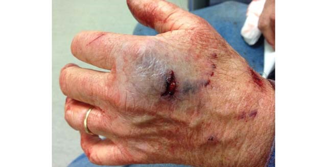 The Good Samaritan, 72, shows his injuries after trying to help get the out-of-control dog away from its 21-year-old victim. He described the Rottweiler/pitbull cross as a 'killing machine.'