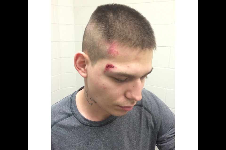 A photo showing injuries Cuyler Richard Aubichon received during his arrest in February by Prince George RCMP.