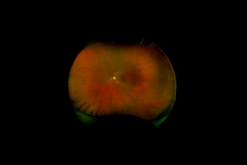 Reporter Jennifer Thuncher's eye as seen through the Optomap machine.