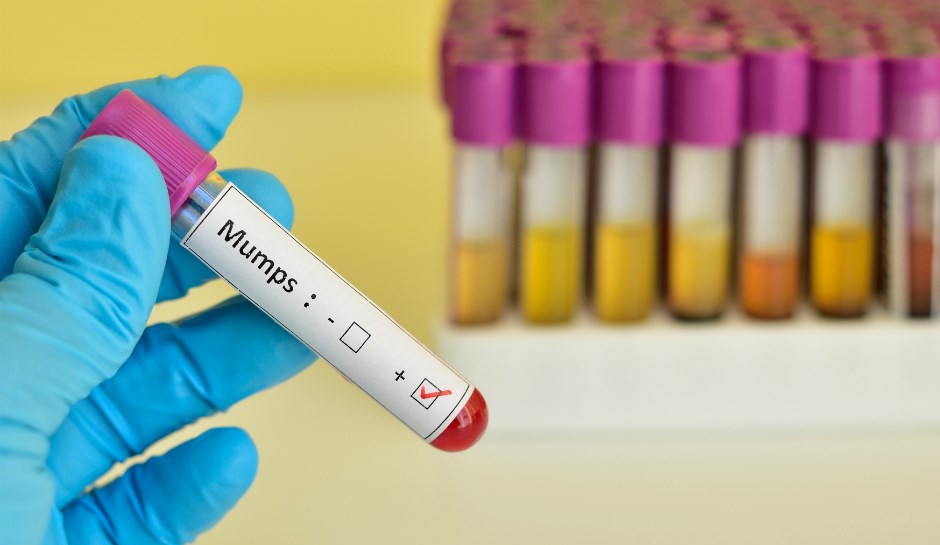 mumps