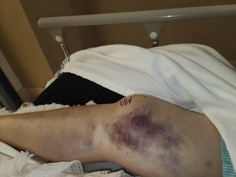 A Jan. 12 photo taken at Thompson General Hospital shows Carol Wood’s leg before she had surgery for