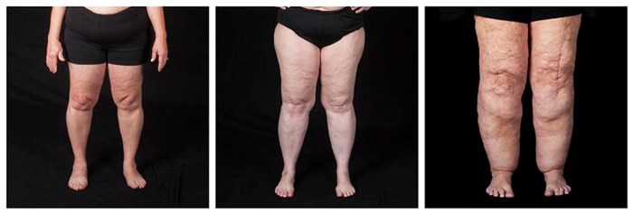 Lipedema Awareness Month 2023