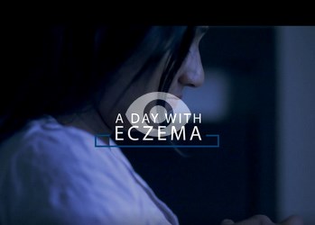 eczema