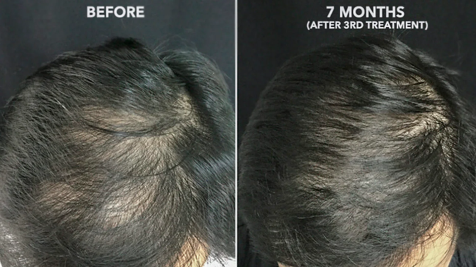 before-after-prp-for-hair-loss-treatments