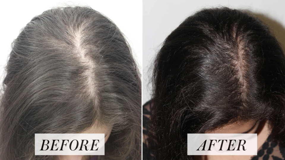 before-after-prp-for-hair-treatments-woman
