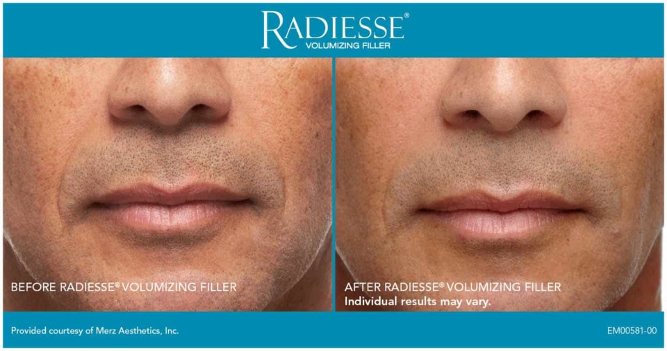 radiesse-front-smile-lines-1-male