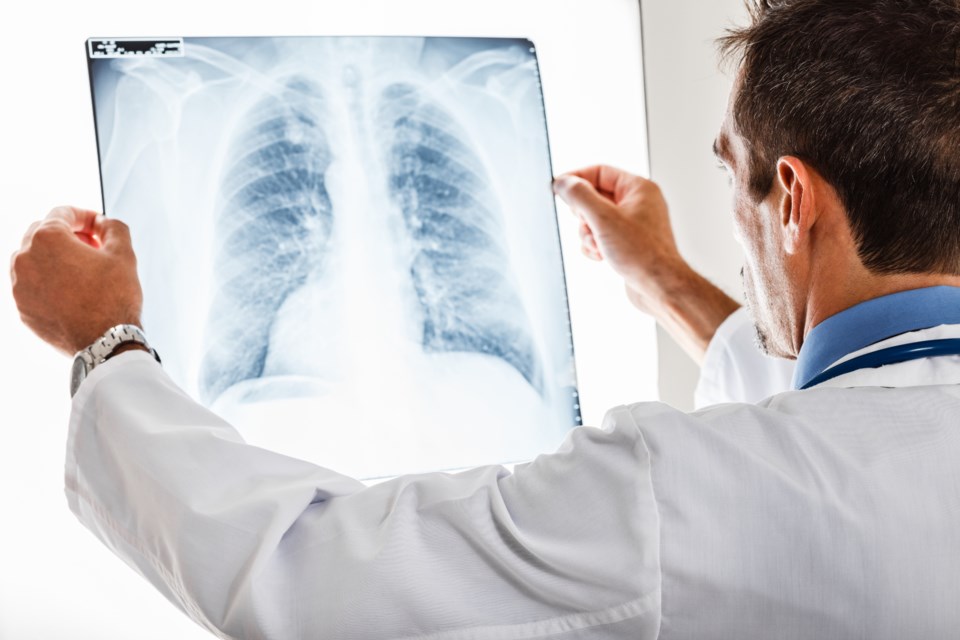 022819-x ray-lung cancer-AdobeStock_46069496