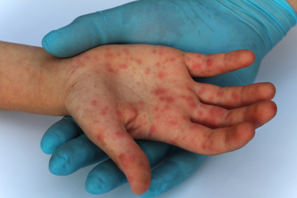 measles-stock-photo