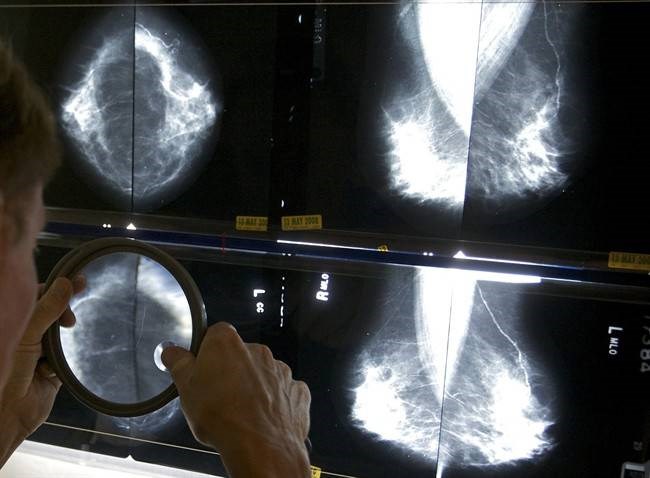 breast-cancer-mammogram