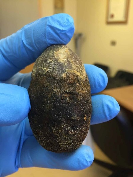Dr. Iftikhar Ahmad removed a huge gallstone from a patient at the St. Paul hospital last Thursday. The gallstone is pictured and measured about six centimetres lengthwise.
