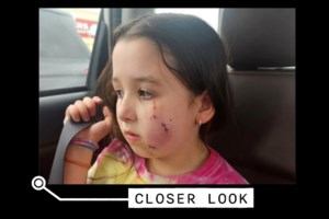 VIDEO: ‘This dog is going to kill someone,’ warns mom of young girl bit in face