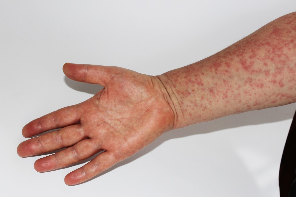 Collin County Health Officials Warn Of Measles Exposure At 3 Plano Stores