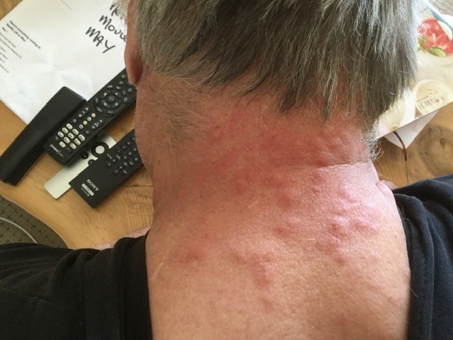 A local resident shows a rash attributed to European gypsy moths.