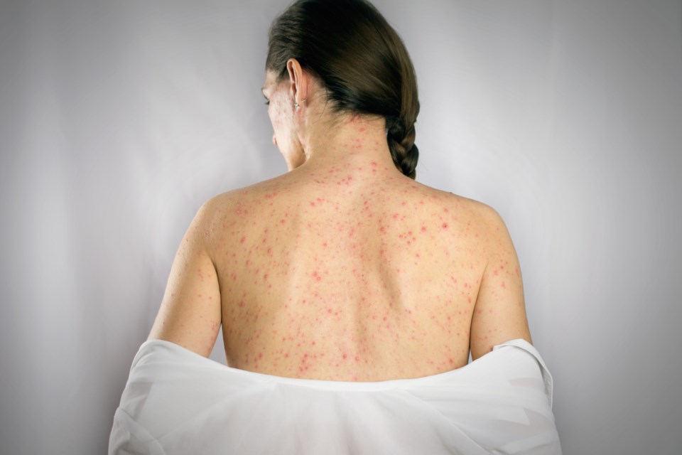 Public health warns of potential for measles after March Break ...