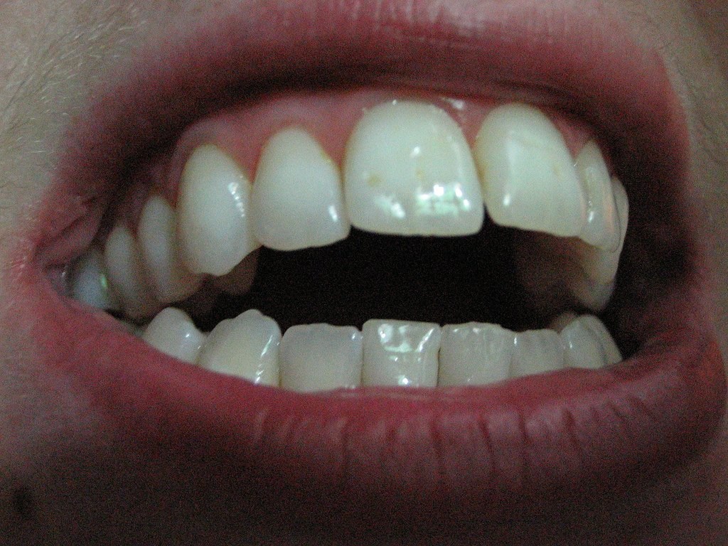 Seniors’ dental eligibility thresholds lifted. Continue to as well reduced say critics