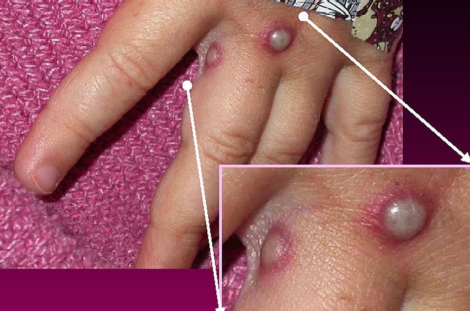 monkeypox hand