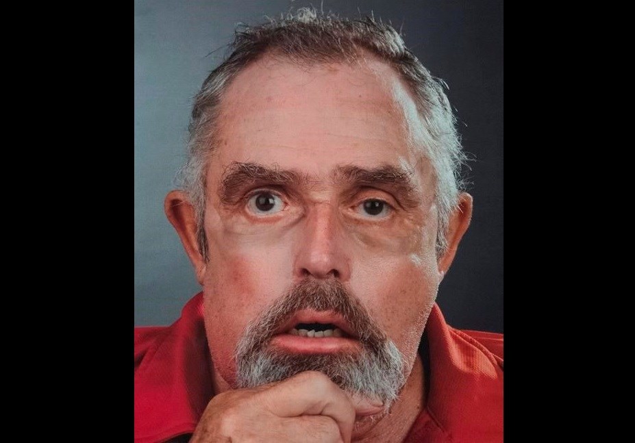 Gatineau-area man doing well after the first ever Canadian face transplant - CityNews Ottawa Gatineau-area man doing well after the first ever Canadian face transplant - CityNews Ottawa