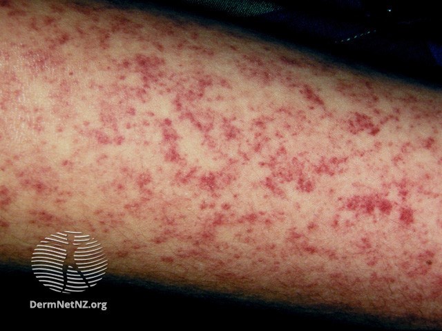 Measles is commonly associated with a red and itchy skin rash. 