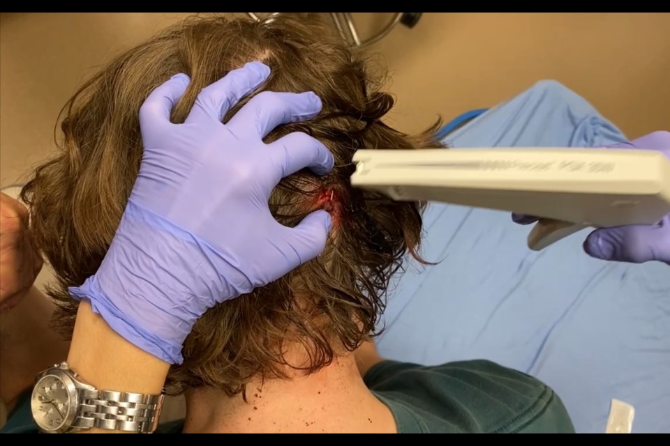 Queen Creek student Connor Jarnagan had to get staples in his head after he was attacked by another teen using brass knuckles on Dec. 30, 2022 at the SanTan Village Marketplace In-N-Out in Gilbert.