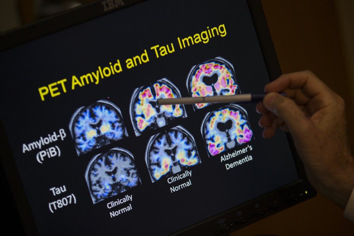 FDA Approves First Blood Test for Alzheimer’s Diagnosis