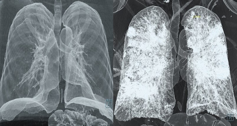 ct-scan-covid-19-lungs