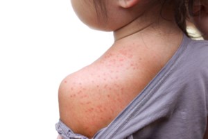 New measles case linked to multiple travel locations in Ontario