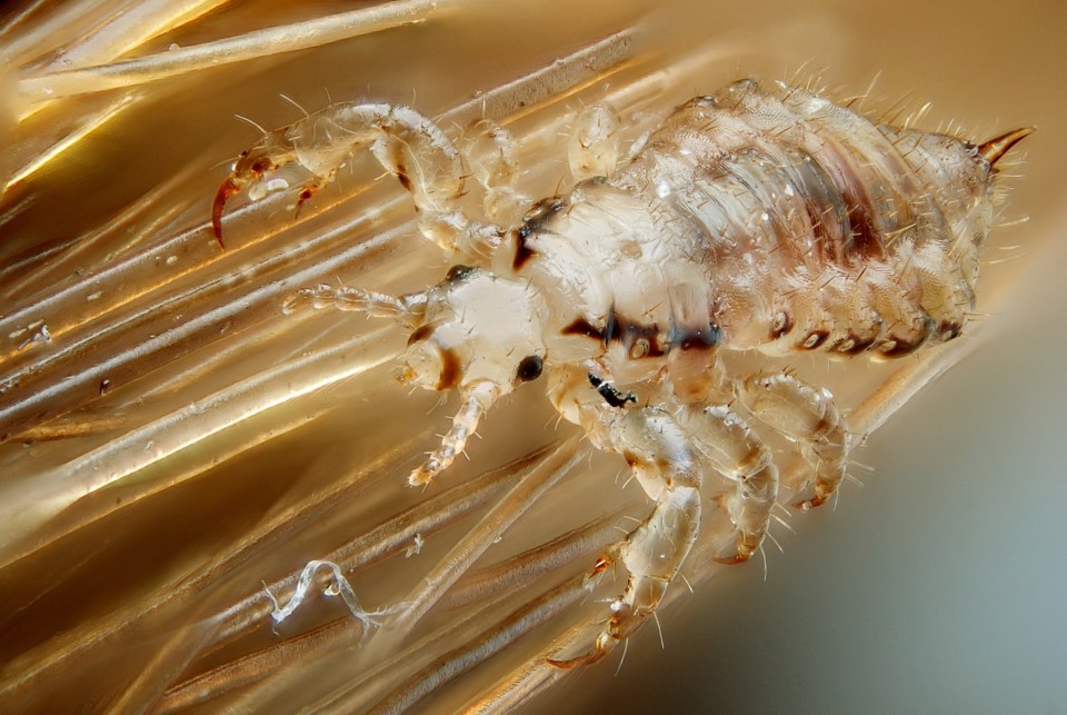 Ask the Nutritionist: How do you treat lice naturally and keep them away? - Bradford News Ask the Nutritionist: How do you treat lice naturally and keep them away? - Bradford News